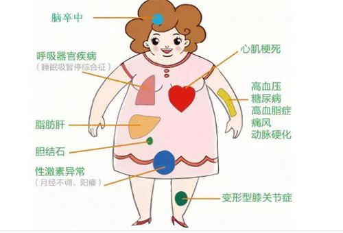 對肥胖大聲說NO!——我院開展腹腔鏡（微創(chuàng)）下胃部分切除術(shù)