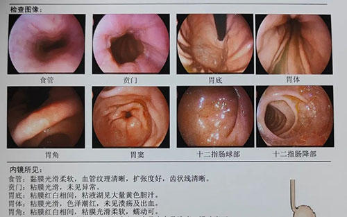對肥胖大聲說NO!——我院開展腹腔鏡（微創(chuàng)）下胃部分切除術(shù)