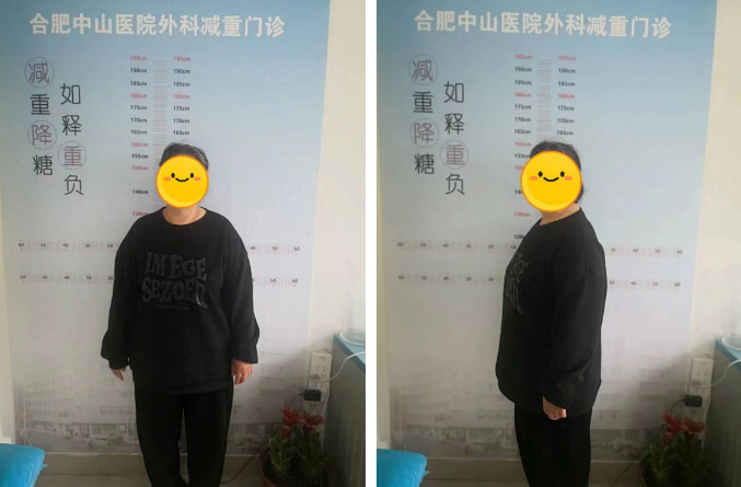 減重代謝手術(shù)，減的不只是“體重”