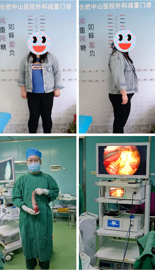 減重代謝手術(shù)，減的不只是“體重”