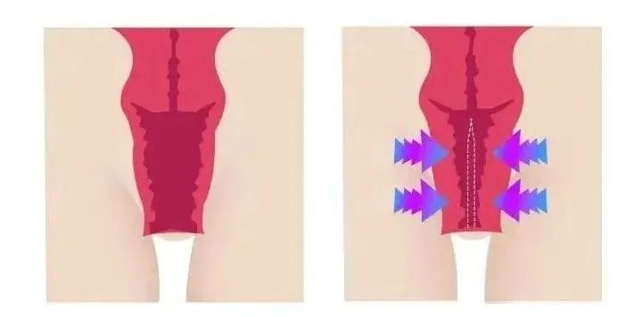 媽媽們！尿失禁，絕不是正?，F(xiàn)象！