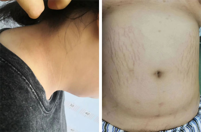 15歲女孩體重達(dá)210多斤，減肥之路我們一同陪伴……