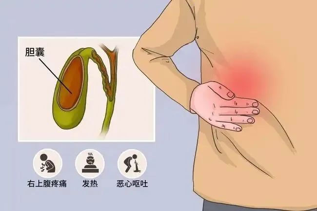 膽囊竟如同一顆松花蛋？這個進(jìn)展迅速的疾病需警惕！