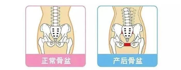 盆底肌修復(fù)究竟有多重要？