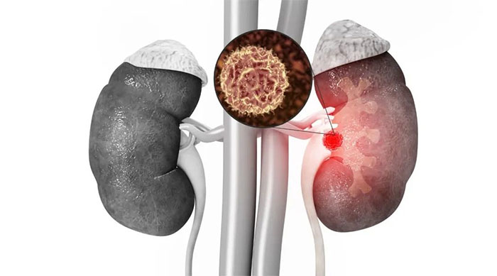 小小結(jié)石竟然讓人丟掉一個(gè)腎？體檢查出腎結(jié)石怎么辦？