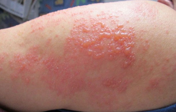 有一種劇痛叫“帶狀皰疹”，這些人群需警惕！