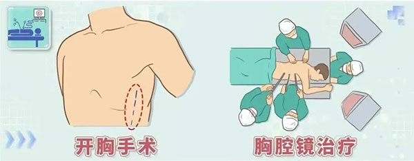 小切口解決大問題！醫(yī)生帶您了解胸腔鏡手術(shù)......