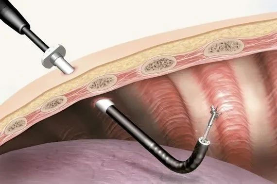 小切口解決大問題！醫(yī)生帶您了解胸腔鏡手術(shù)......