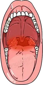 “三陽”還是咽喉疾??？