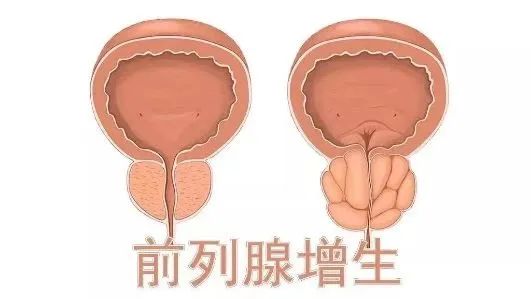 前列腺增生｜從癥狀到治療一文說清！