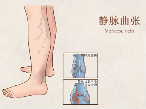 夏日炎炎，你的小腿上也有“小蚯蚓”嗎？