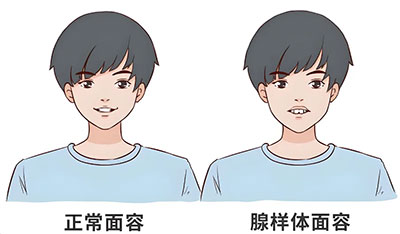 凸嘴、齙牙、長(zhǎng)相變樣......別讓腺樣體面容影響了孩子的一生