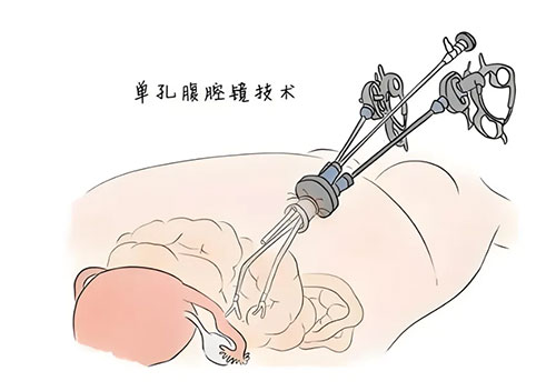 “一孔之術(shù)”，讓你無壓力“炫腹”——單孔腹腔鏡手術(shù)