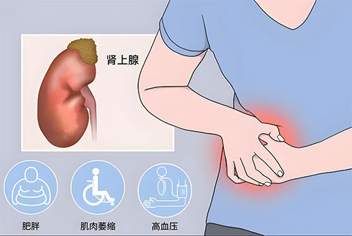 “高血壓、腹痛.....”——注意腎上腺腺瘤找上門