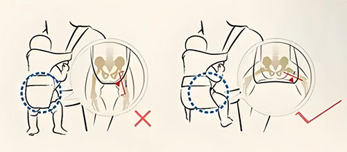 【惠民科普】你的髖關(guān)節(jié)真的發(fā)育好了嗎？——成人先天性髖關(guān)節(jié)發(fā)育不良