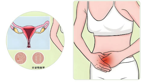 盆腔里的“不速之客”|揭秘包塊真相，守護(hù)您的“隱秘花園”