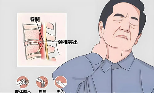 【惠民科普】從“頸”開(kāi)始，守護(hù)未來(lái)——脊髓型頸椎病