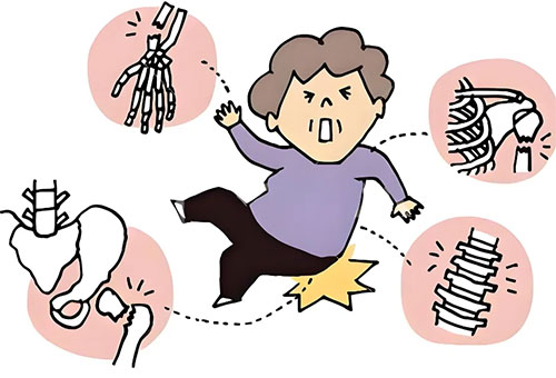 【惠民科普】“少怕歪，老怕摔”警惕中老年人群的‘頭號殺手’——骨折