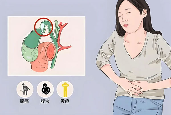【惠民科普】消化道的定時炸彈——“膽”小事大的急性膽囊炎