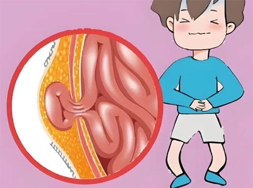 【惠民科普】“小鼓包”暗藏“大隱患”——不可忽視的疝氣