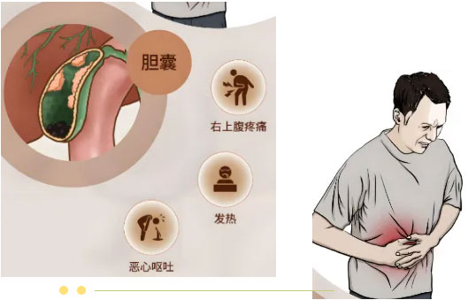 【惠民科普】腹脹、惡心、嘔吐......這種癥狀不一定是胃病，還可能是結(jié)石性膽囊炎！
