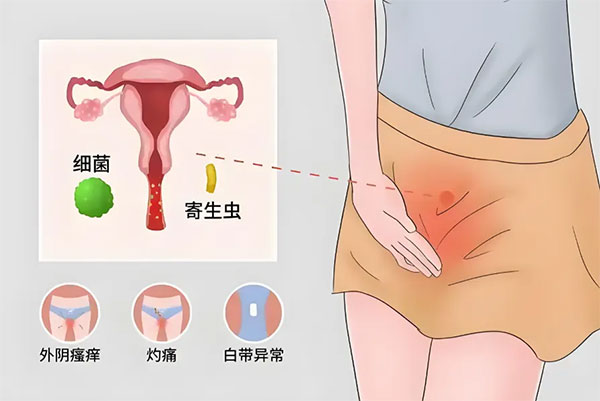 【惠民科普】女性的難“炎”之隱——陰道炎
